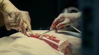 In1x23 surgery