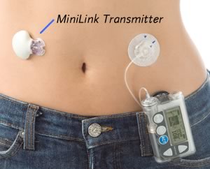 Minimed CGMS