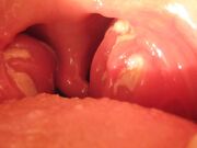 Mononucleose