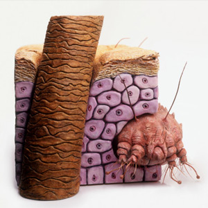 Scabies-1