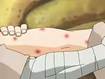 Tenketsu heridos