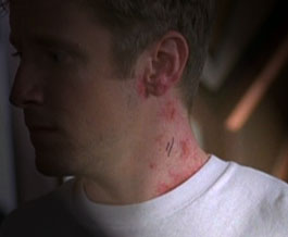Trimeasles