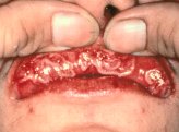 S syphmouth kl