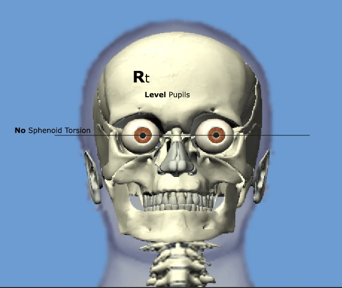 Frontal Plane Divergence of Pupils Sign for Sphenoid Torsion