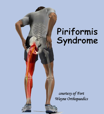 Piriformis syndrome что за болезнь