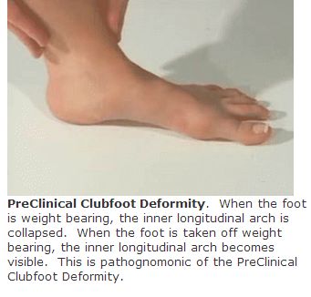 Clubfoot vs PreClinical Clubfoot Deformity. A Technical Presentation ...