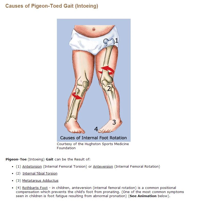 PigeonToed (Intoeing) Determining the Cause Athlepedia, The Athletics Wiki Fandom