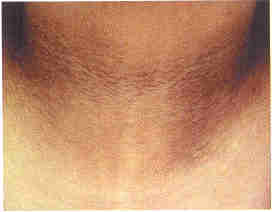 Acanthosis nigricans
