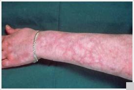 Livedo reticularis