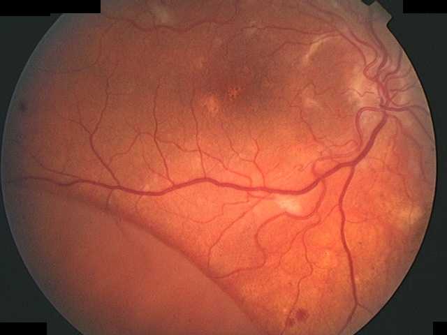 Detachedretina
