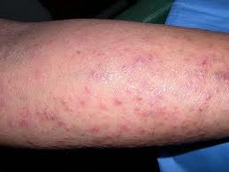 Dermatitis herpetiformis