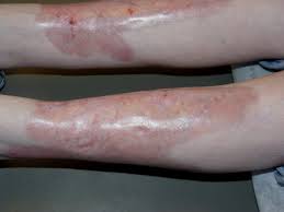 Nicrobiosis