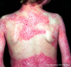 Dermatomyositis