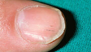 Splinter