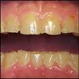 Bruxism