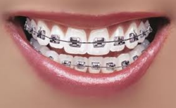 Characters who wear Braces