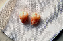 Wisdom teeth 2