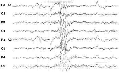 Seizure EEG