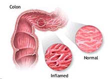 Inflammatory bowel disease