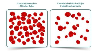 Anemia ferropénica | Enseñamos para que Aprendan Wiki | Fandom
