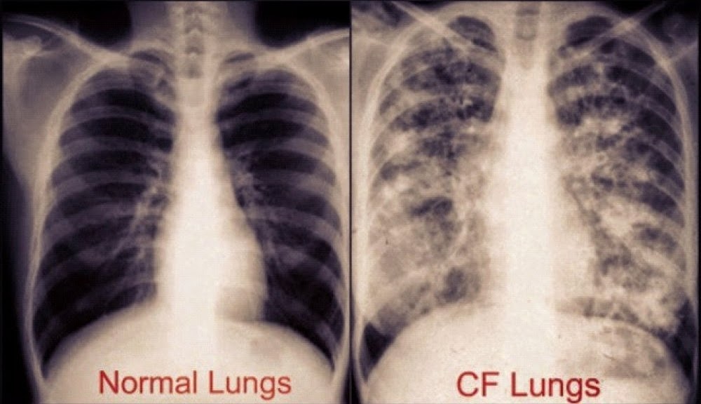 Cystic Fibrosis | Fragile Wikia | Fandom