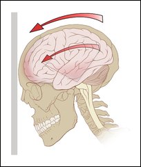 FBW Concussion