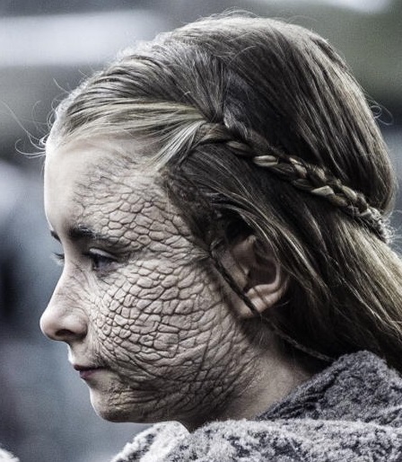 https://vignette.wikia.nocookie.net/gameofthrones/images/9/96/505_Shireen_greyscale_closeup.jpg/revision/latest?cb=20161215031005