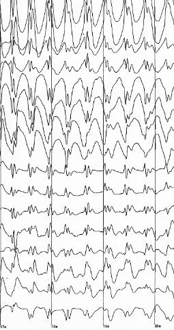Talon's Epileptic EEG Waves