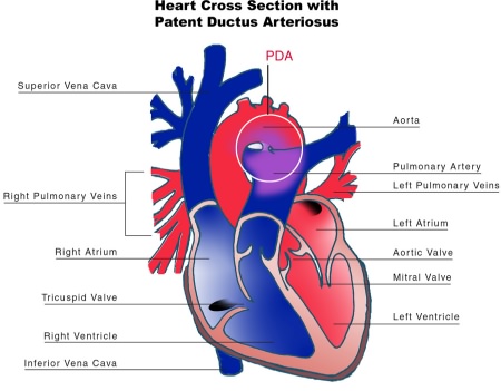 patent ductus arteriosus house wiki fandom powered by wikia patent ductus arteriosus