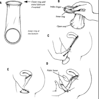 Female Condoms Human Sexuality Wiki Fandom