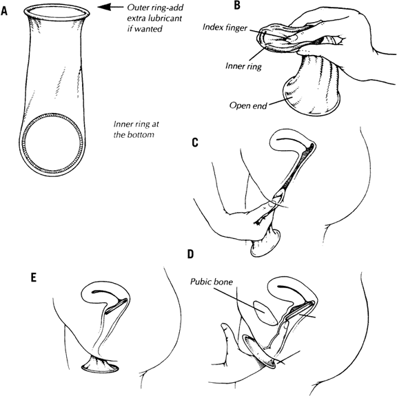 Female Condoms Human Sexuality Wiki Fandom Powered By Wikia