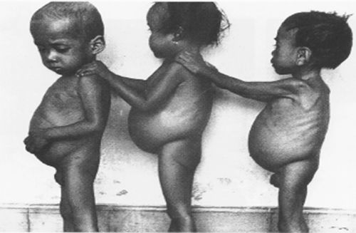 Kwashiorkor.fig2