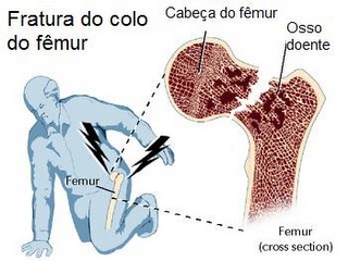 Osteoporose3