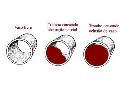 Formação do trombo