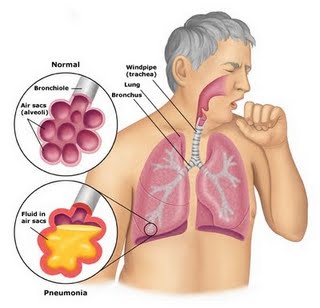 Pneumonia Infomedica Wiki Fandom
