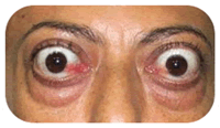 Tireoide5