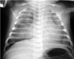 Resp.Neonato 2