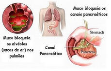 Fig.fibrosecistica.2.jpg