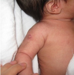 Tuberculose7