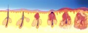 M108788-Illustration of Acne-SPL