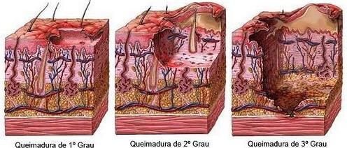 Graus queimadura
