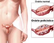 Síndrome Ovários Policísticos