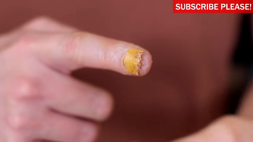 NASTY NAIL FUNGUS! | JesseAndMike Wiki | Fandom