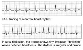 Arrhythmia Chart