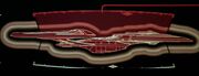 Dorsal shield failure