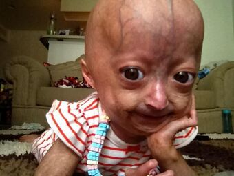 Genetics Of Progeria Mmg 233 2014 Genetics Genomics Wiki Fandom