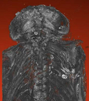 Anencephalic
