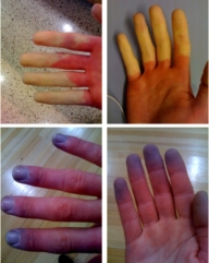 Raynaud's syndrome