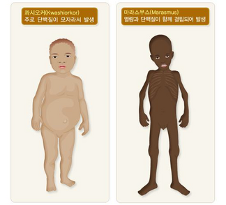 단백질 결핍증