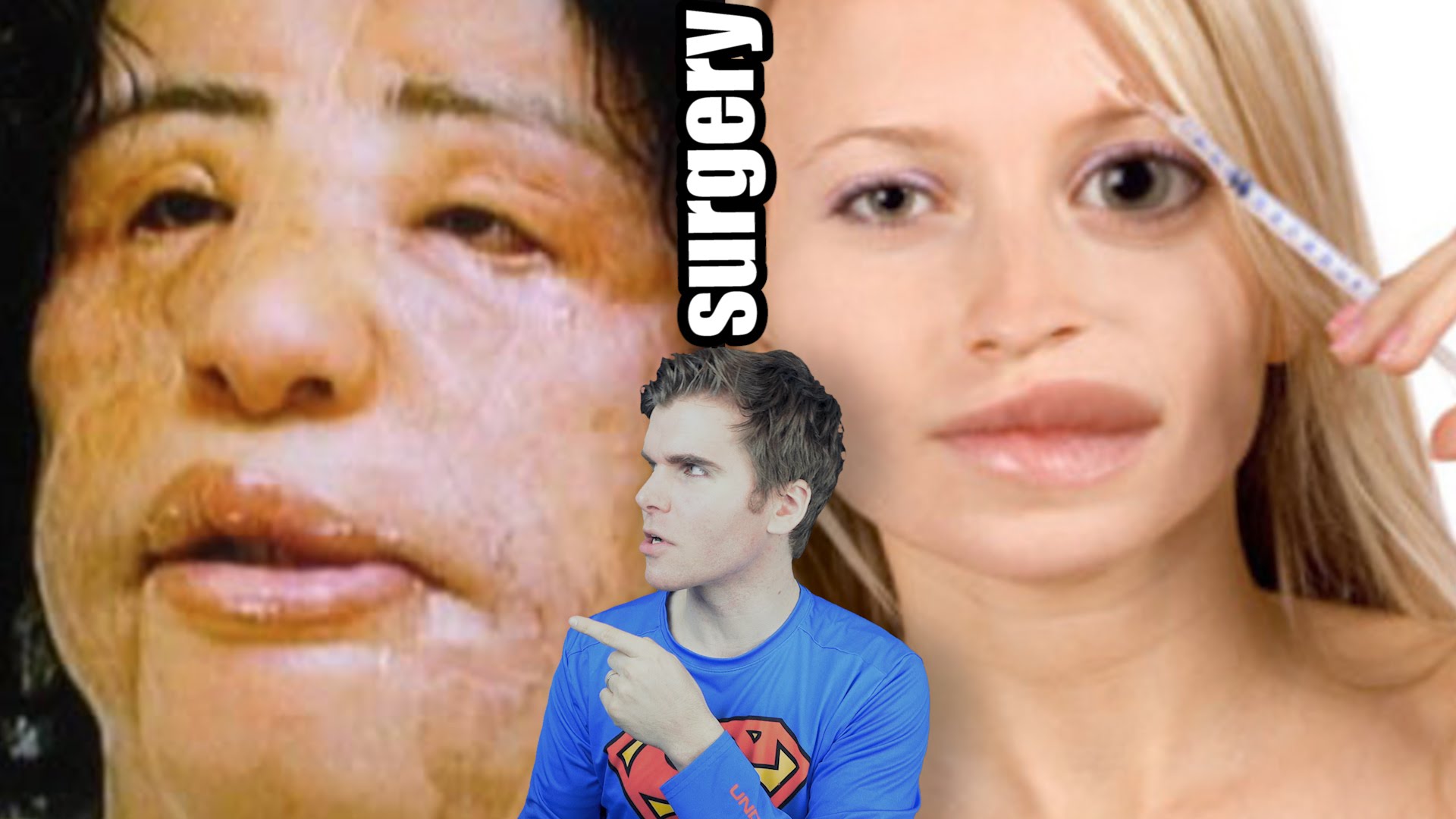 Plastic Surgery Gone Wrong (Before And After) | Onision Wiki | Fandom
